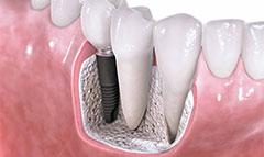 Имплантация