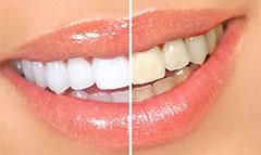 Отбеливание зубов