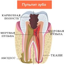 Пульпит