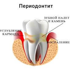 Периодонтит