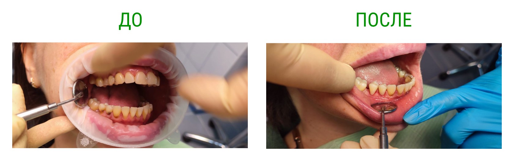 before after caries